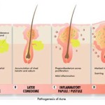 patogenesi dellacne - come si forma il brufolo