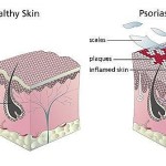 psoriasis1