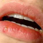 Labbra secche e screpolate